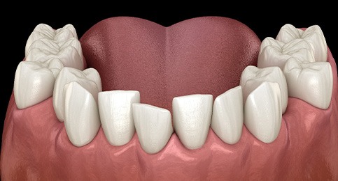 Illustration of crooked teeth