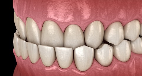 Illustration of an underbite