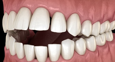 Illustration of an open bite