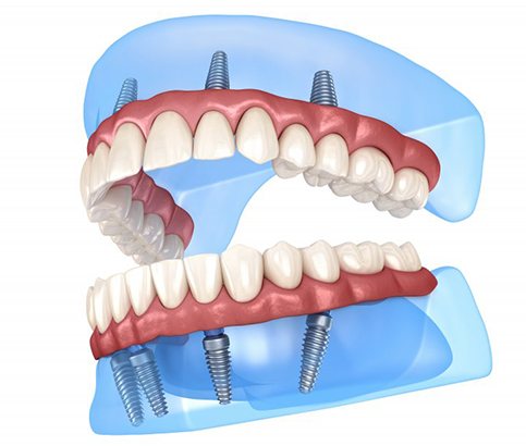 a 3D illustration of All-on-4 dental implants