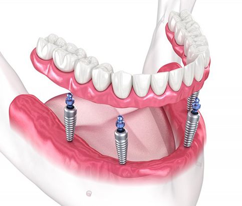 a 3D illustration of All-on-4 implants