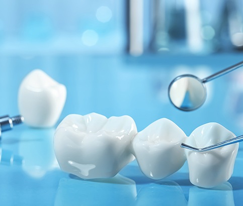 Dental bridge and implant on reflective blue surface next to dental mirror