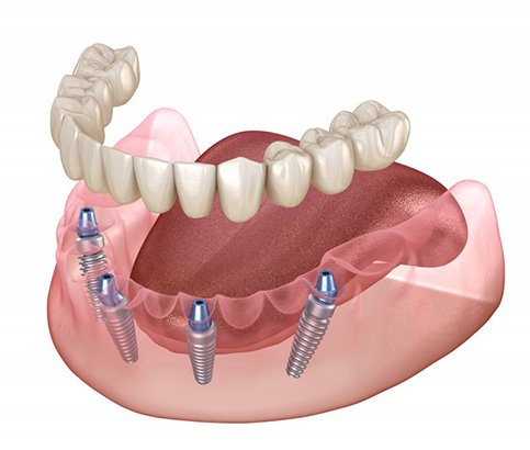 Digital diagram of implant dentures