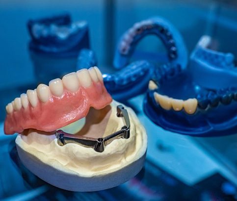 An implant denture being completed in a lab